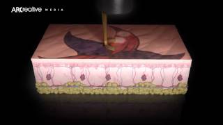 Tattoo Removal  Picoway Resolve Teaser 3D Medical Device Animation [upl. by Kylah]