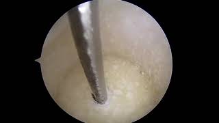 Subchondral Solutions  Clinical Video for PFJ [upl. by Llenehs]