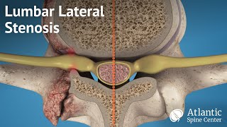 Lumbar Lateral Stenosis [upl. by Notnirt957]