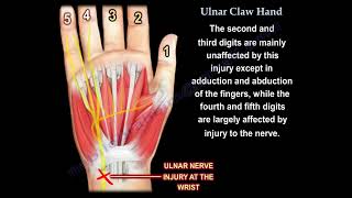 Ulnar Claw Hand Deformity Diagnosis Causes and Differential Diagnosis [upl. by Schonthal920]