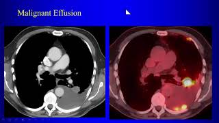 3b Lung Cancer P2 [upl. by Halbeib]