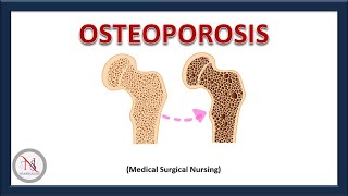 OSTEOPOROSIS  Causes  Pathophysiology  Treatment  Nursing Management  The Nurses Station [upl. by Aissyla]