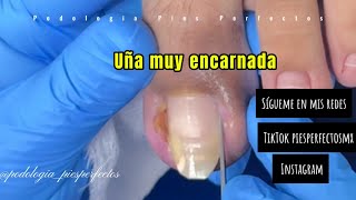 UÑA ENCARNADA BILATERAL satisfying onicocriptosis [upl. by Xuerd186]