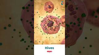 Hives and Your Skin ↪ 3D Medical Animation Shorts Hives Skin HivesDisease SkinDisease [upl. by Anawik949]