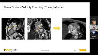 Valvular Heart Disease Evaluation with Cardiovascular Magnetic Resonance  Mohammed Makkiya MD [upl. by Nairadal548]