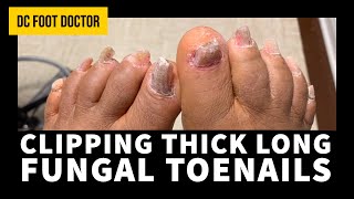 Clipping Thick Long Fungal Toenails [upl. by Dominus]