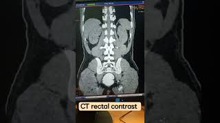 CT SCAN OF RECTAL CONTRAST EXAMINATION [upl. by Nolyak]