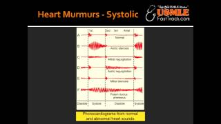 Heart Murmurs  Aortic Stenosis [upl. by Byron250]