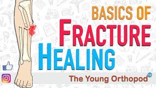 Fracture Healing  ANIMATION  BASICS  The Young Orthopod [upl. by Ayahs]