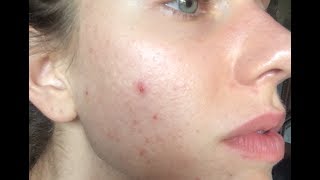 ACNE UPDATE  PHOTOS My Current Summer Skin [upl. by Elayne667]