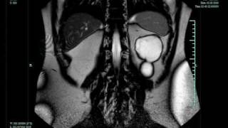 Cyst on Kidney [upl. by Eiramassenav850]