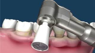 Cleaning of dental plaque [upl. by Nwhas]