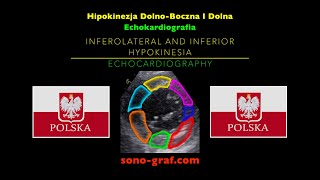 Echokardiografia  Hipokinezja DolnoBoczna I Dolna [upl. by Magnuson]