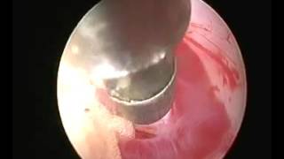 L5S1 full endoscopic interlaminar discectomy [upl. by Iznekcam]