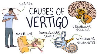 Understanding the Causes of Vertigo [upl. by Annairoc462]