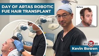 Watch an ARTAS Robotic FUE Hair Transplant  We Grow Hair Indy VIP Kevin Bowen Day of Procedure [upl. by Tumer]