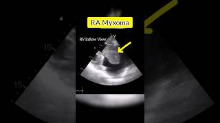 Myxoma in RA  Echocardiography For Beginners echocardiogram shorts [upl. by Arrakat]