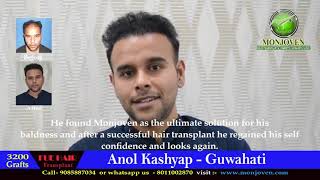 Anol kashyap Hair Transplant in Guwahati [upl. by Puttergill]