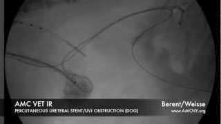 AMC IR perc ureteral stent TCC [upl. by Perl]