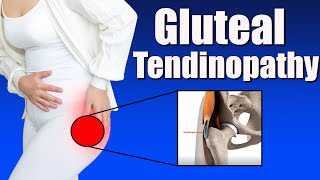 Gluteal Tendinopathy Symptoms Causes and Effective Exercises for Greater Trochanter Pain [upl. by Dahsar]