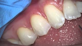 What healthy gums look like [upl. by Hendrix]