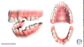 Crowding with Protruding Teeth Extractions [upl. by Jump]