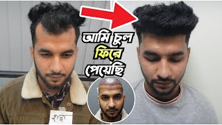 আমি সেরা রেজাল্ট পেয়েছি  Best Result  Hair Transplant Bangladesh hairtransplantbangladesh [upl. by Nosdivad]