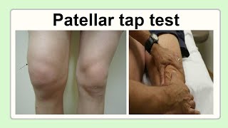 patellar tap test [upl. by Eiznekcam]