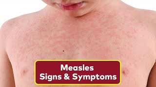 The 3 Warning Signs of Measles To Look Out For  How To Spot Measles Rash [upl. by Gluck]