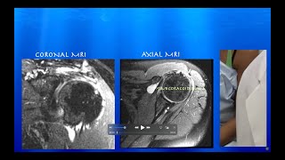 Ultrasound of SubcoracoidSubdeltoid Bursitis amp Partial vs SmallFull Thickness Supraspinatus Tear [upl. by Trebleda73]