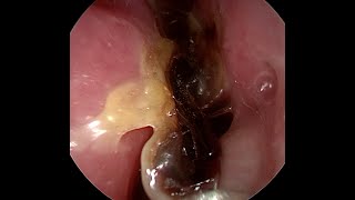 BIG BOOGERS and SNOT after Septoplasty [upl. by Furey]