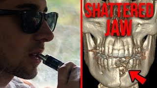 Vape Explodes In Man’s Mouth And Shatters His Jaw [upl. by Yrakaz]