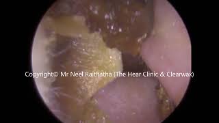 242  Soft Ear Wax Removal using Jobson Horne  Mr Neel Raithatha The Hear Clinic [upl. by East]