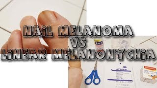 Nail Melanoma VS Melanonychia  learn from my story [upl. by Ateuqirne700]