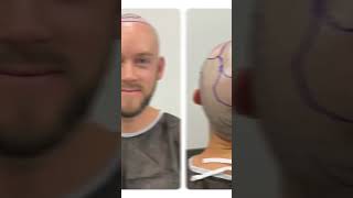 Important Steps Before FUE Hair Transplant Surgery  Longevita [upl. by Pillihp734]