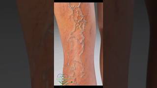 Varicose veins 3d Animation anatomy meded 3dmodle [upl. by Anoyek]