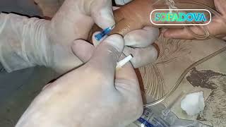 intravenous injection A quick way to get a shot in a vein [upl. by Charo]