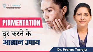 Pigmentation दूर करने के आसान उपाय  Tips to Prevent Pigmentation  Clinic Eximus [upl. by Rahm406]