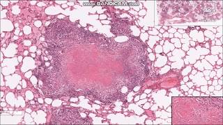 Tuberculosis Granulomas  Histopathology slides [upl. by Eaned]