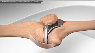 Knee Replacement with the iBalance TKA System [upl. by Anwahsit361]