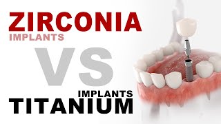 Zirconia Implants VS Titanium Implants  Aria Dental  Maryam Horiyat DDS [upl. by Zweig]