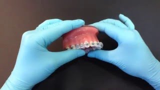 How to use orthodontic wax [upl. by Uta]