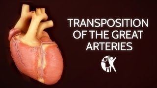 Transposition of the Great Arteries [upl. by Drofnas201]