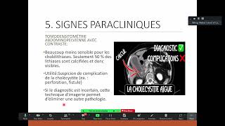 Cholécystite aigue Dr AING PITOU [upl. by Ralip]