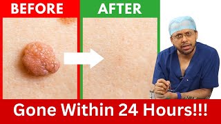 How to Rid Skin Tags and Warts Within 24 Hours  Dr Sanjay Sarkar on Skin Tag Removal [upl. by Raquela]