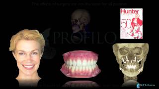 Bimaxillary Orthognathic Facial Cosmetic Plastic Jaw Surgery [upl. by Hump]