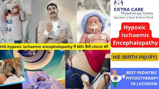 Hypoxic Ischaemic Encephalopathy  HIE in Babies Birth Injury  Pediatric Physiotherapy in Lucknow [upl. by Nodrog910]