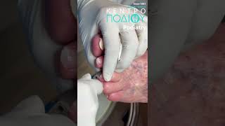 Nails Treatment callus κεντροποδιου kentropodiou podiatry podiatria podologia podiatrist [upl. by Jun]