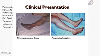 Phlegmasia Cerulea Dolens VS Phlegmasia Alba Dolens  Deep Vein Thrombosis  Signs and Symptoms [upl. by Orag]