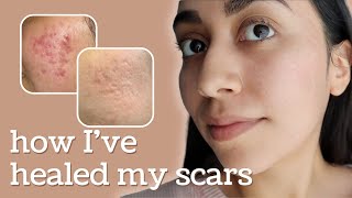 Healing Hyperpigmentation  Deep Pitted Acne Scars this is what I’ve done [upl. by Meean]